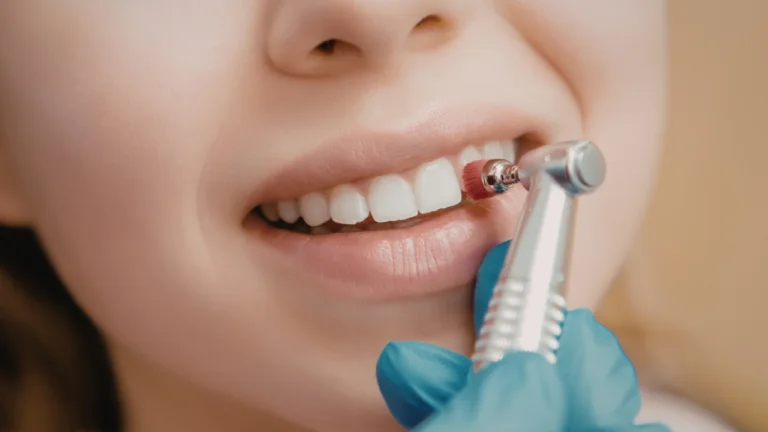 Teeth Whitening: Professional vs Home Methods