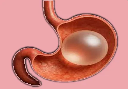 Gastric Botox